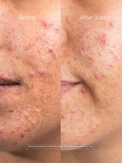 EraZit Magnesium Microneedle Patch