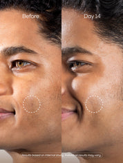 Brightening Microdart Patch