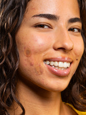 Brightening Microdart Patch