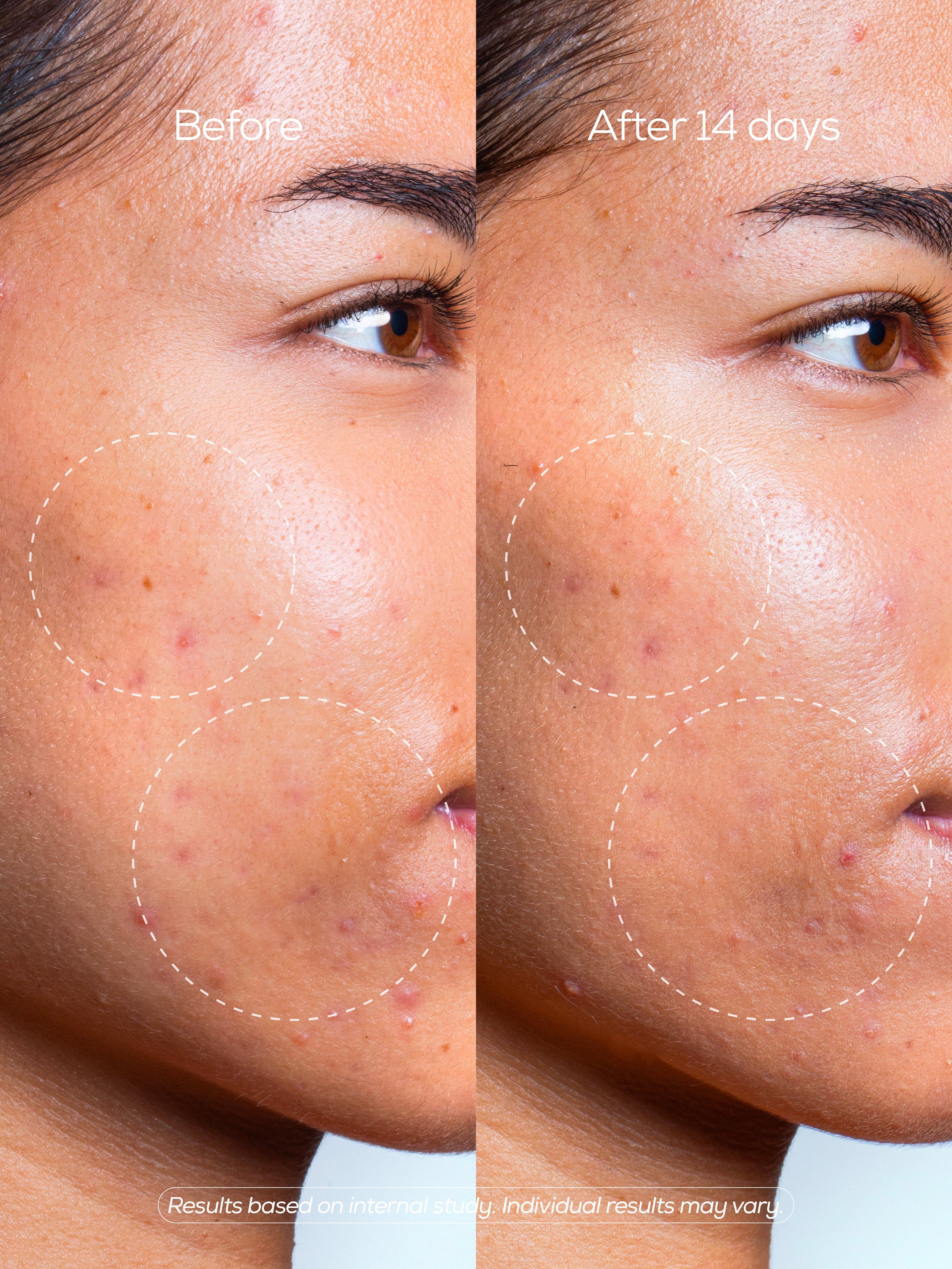 Post-Blemish Corrector with Ceramide